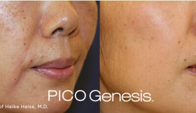 Heard of PICO Genesis? If you have unwanted age spots or brown spots, this is the treatment for you!