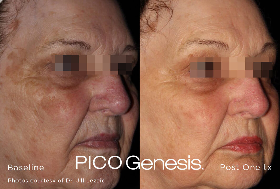 enlighten_pico-genesis_10