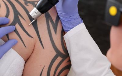 Tattoo Regret? Try Laser Tattoo Removal