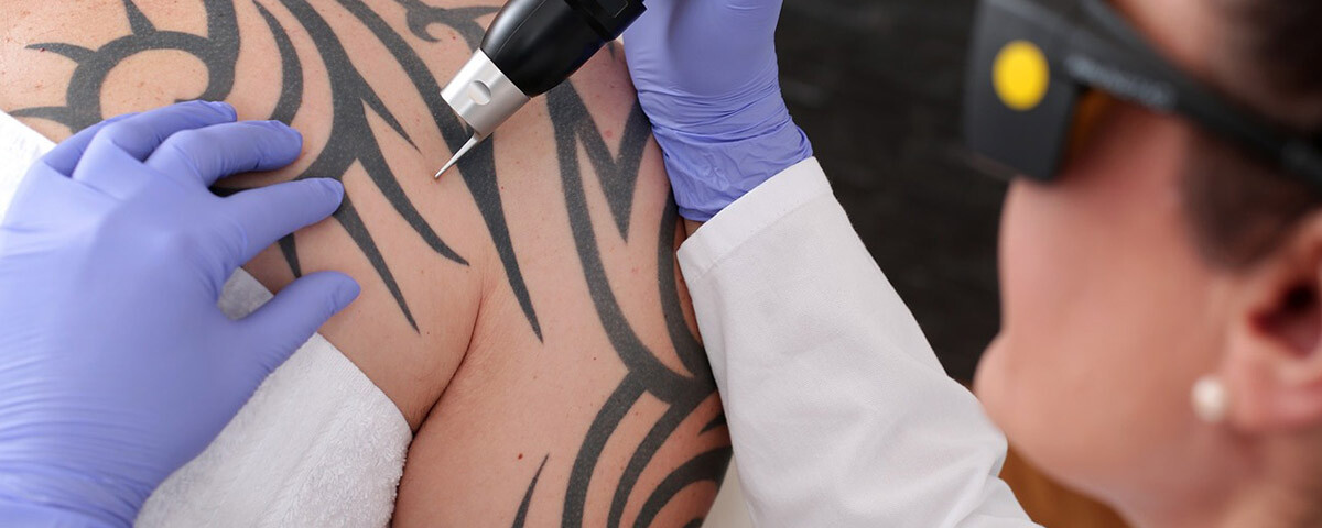 Tattoo Regret? Try Laser Tattoo Removal