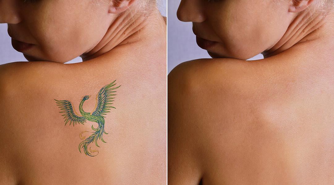 The 10 Most Frequently Asked Questions about Laser Tattoo Removal