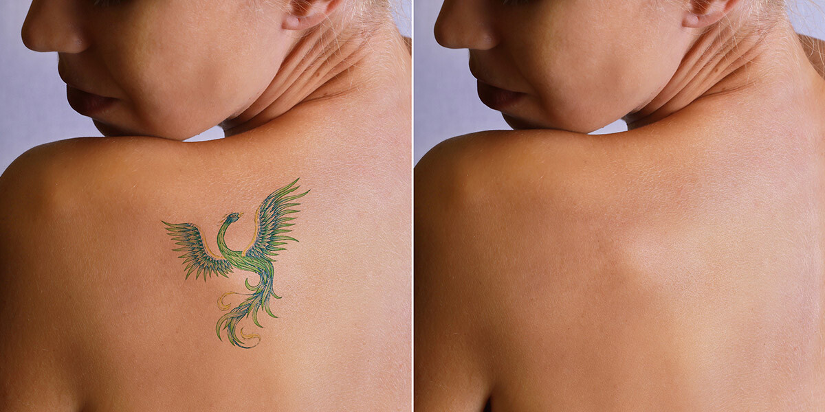 The 10 Most Frequently Asked Questions about Laser Tattoo Removal -