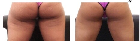buttocks and back hips Before and After UltraSmooth treatment