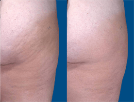 cellulite before and after UltraSmooth treatment