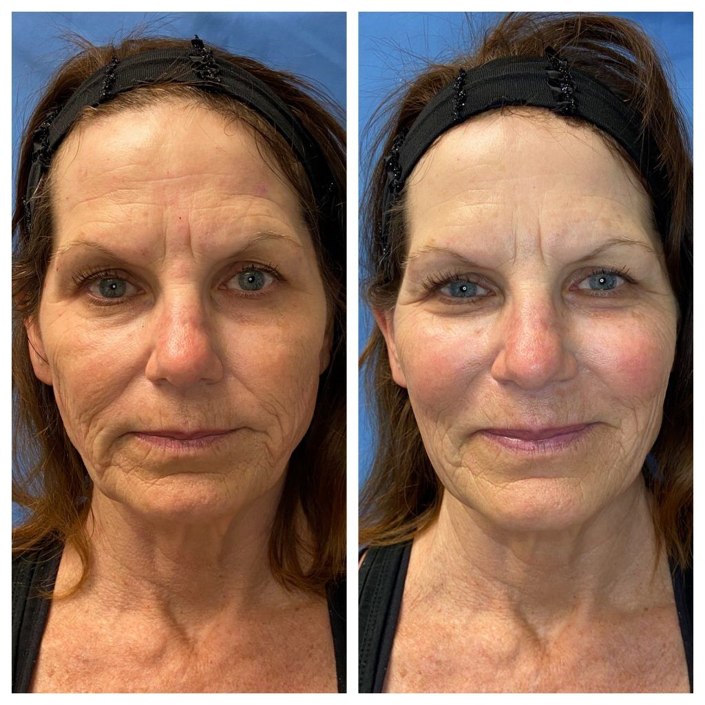 PDO threading nonsurgical skin lift San Diego San Diego / La Mesa CA