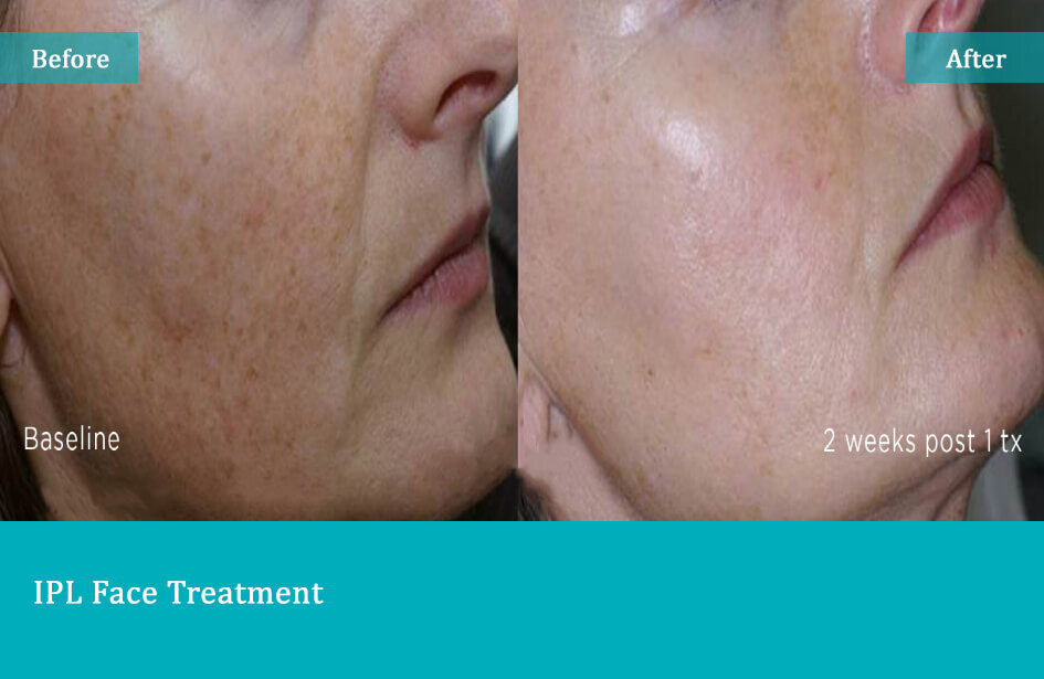 Before-after-3