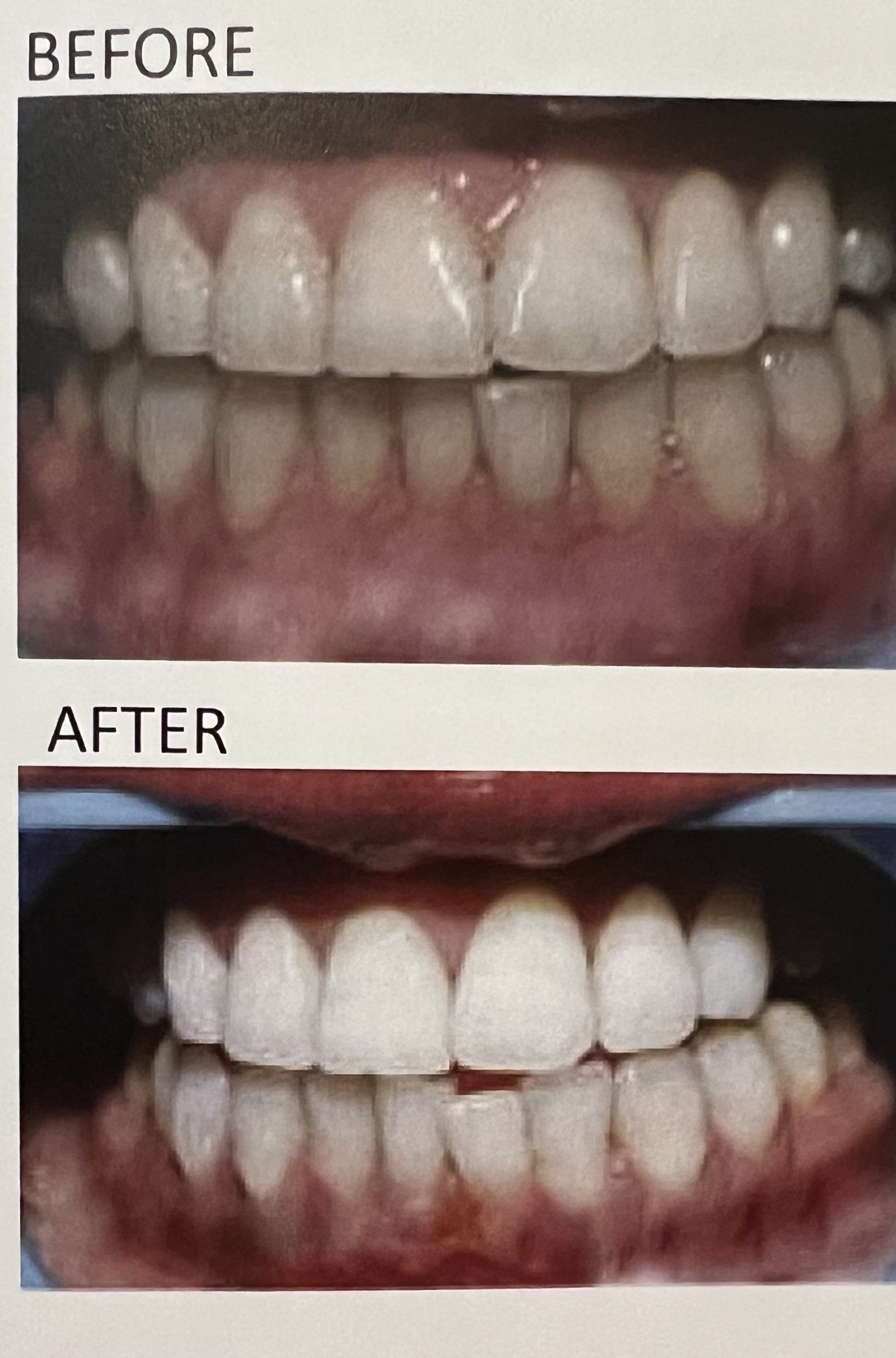 Before after DaVinci whitening