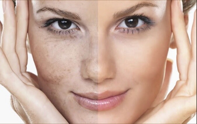 chemical-peel
