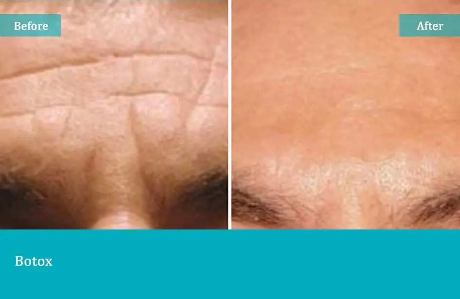 Before-after-4