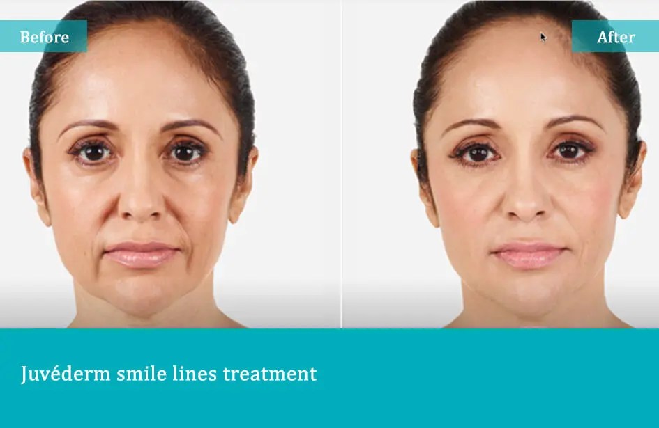 Before-after-5-1