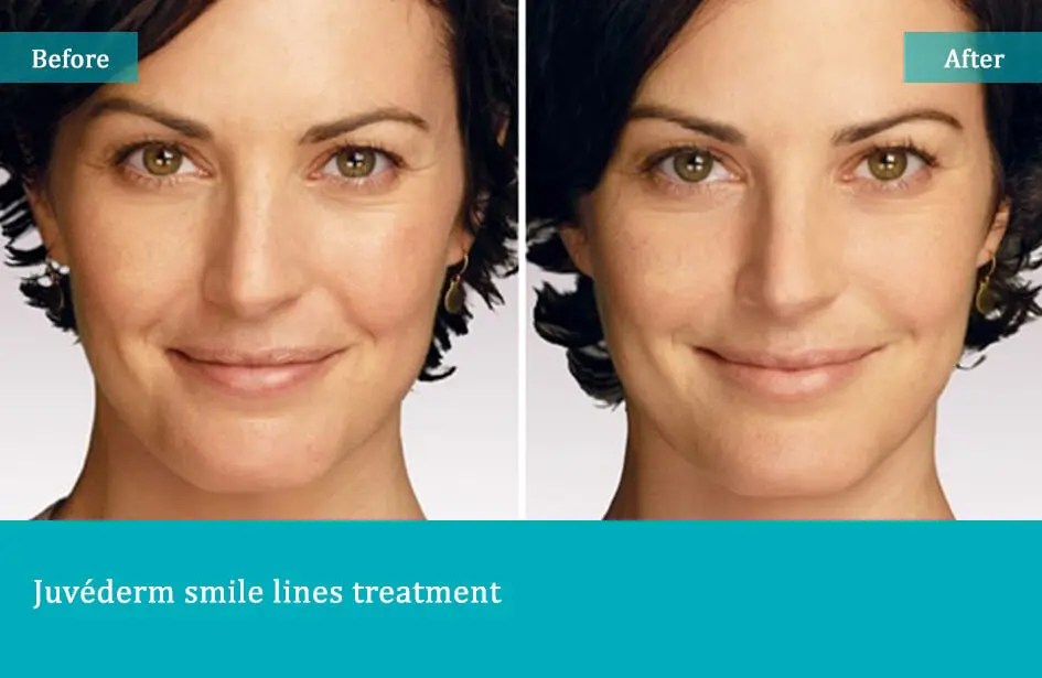 Before-after-5