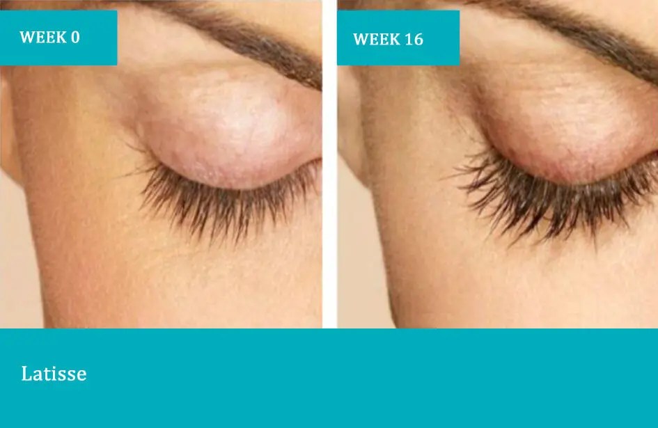 Before-after-6-1