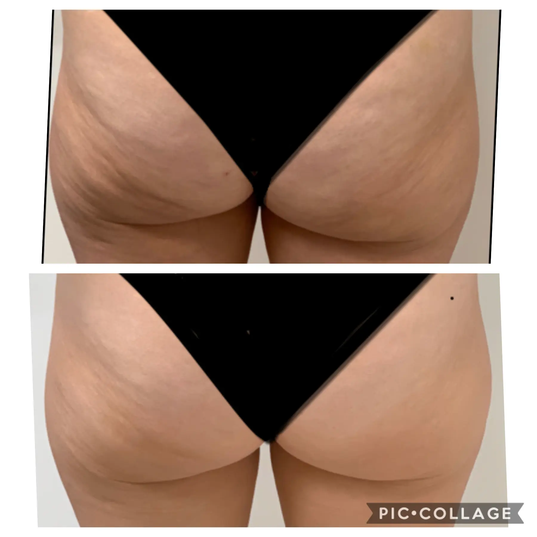 Cellulite-before-after