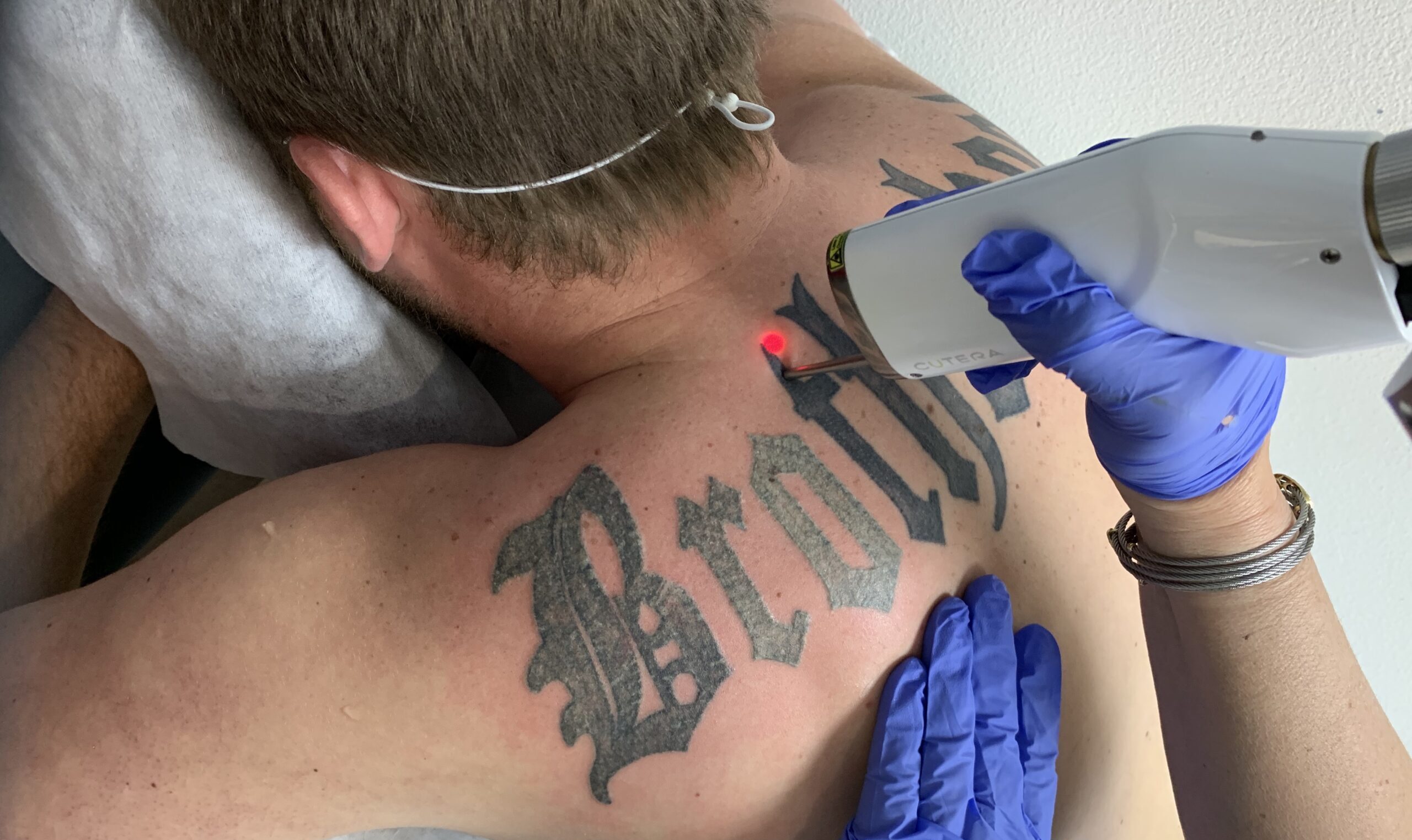 Tattoo-Removal-demonstration-scaled-1 Laser Facials-The Best for Skin Rejuvenation