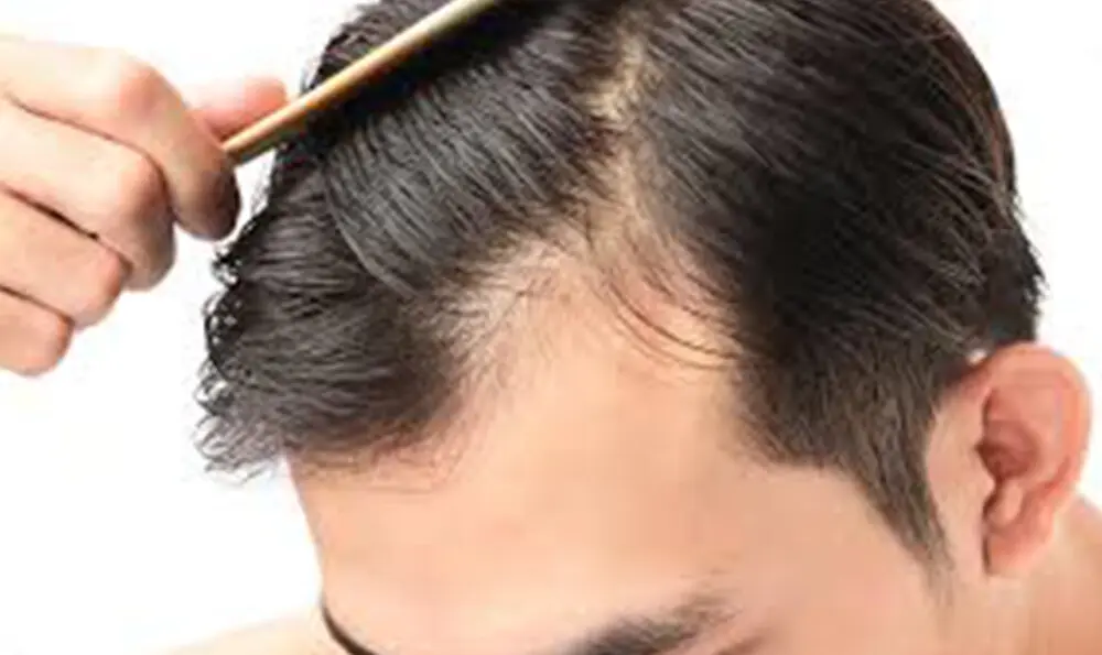 prp-hair-restoration-san-diego
